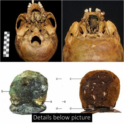 300 Year Old “Exceptional” Prosthesis made of Gold and Copper and wool Discovered in Poland