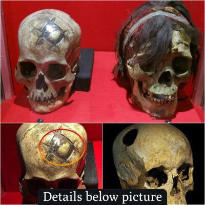 Pioneering Cranioplasty: Early Success Story Unearthed from Ancient Peru